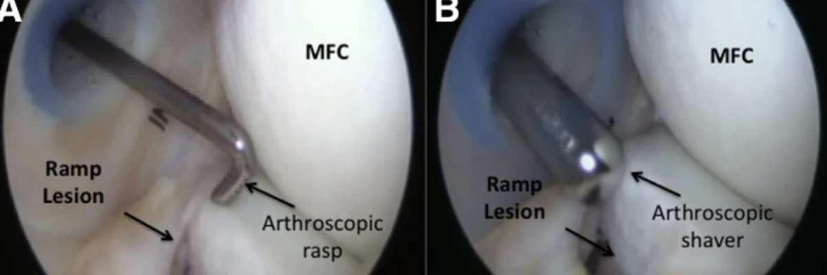 Trephination Ramp Lesion Menisküs Ramp Lezyonlarının Tanısı ve Cerrahi Onarımında İleri ...