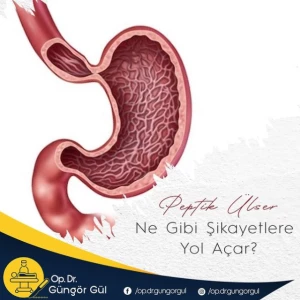 Peptik Ülserler Ne Gibi Şikayetlere Yol Açar? makalesi