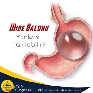Mide Balonu Kimlere Takılabilir? makalesi