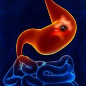 Peptik ülser nedir ? makalesi
