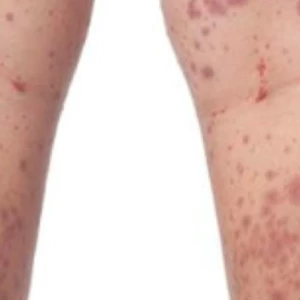 İmmünoglobulin A (IgA) Vasküliti Nedir? Belirtileri ve Tedavi Süreci makalesi
