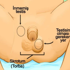 İnmemiş testis (kriptorkidizm) ve asansör testis (retraktil testis) nedir? makalesi