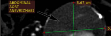 Aort anevrizması nedir?