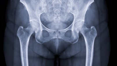 Kalça eklemi osteoartrit ( kireçlenme)