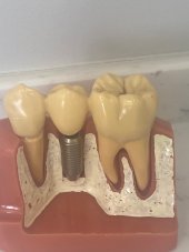 İmplanta neden ihtiyaç duyarız ve implantın ömrü ne kadardır