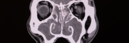 Geçmeyen burun tıkanıklığı: basit bir grip mi, yoksa kronik sinüzit mi?