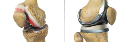 Total diz artroplastisi sonrası fizyoteraopi işlevsellik ve denge