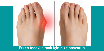 Bunyon nedir?