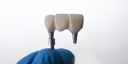 İmplant yapılırken ağrı hissedilir mi? implant tedavisi ağrılı bir işlem midir?