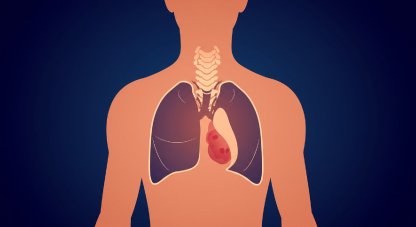 Mediastinal tümör tedavisinde vats (kapalı göğüs cerrahisi) yöntemi