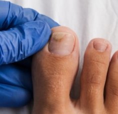 Tırnak boşalması (onikoliz) nedir? neden olur ve nasıl çözülür? 🦶✨