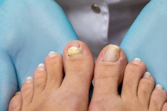 Ayak tırnağı neden etten ayrılır? 😳💅 tırnak düşecek mi?