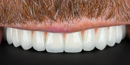 Zirkonyum diş nedir? ne kadar dayanır, doğal görünür mü?