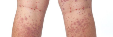 İmmünoglobulin a (ıga) vasküliti nedir? belirtileri ve tedavi süreci