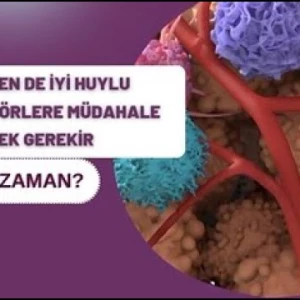İyi Huylu Tümör Nedir?