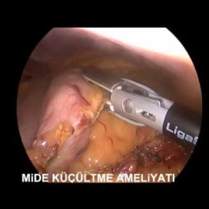Obezite cerrahisi (Sleeve Gastrektomi)
