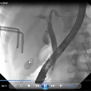 Youtube - Ercp Nasıl Yapılır? Skopi Görüntüleri