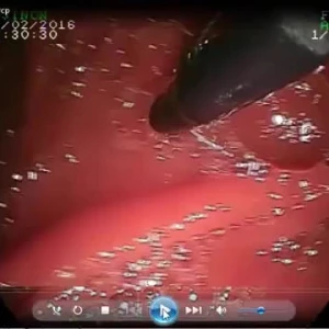 Youtube - Ercp Nasıl Yapılır? Papillotomi ve Taş Çıkarılması