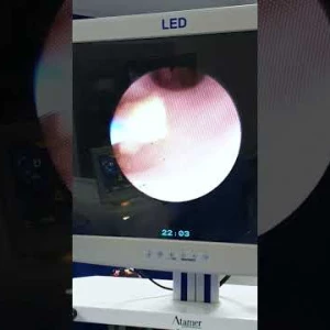 Lazerle Böbrek Taşı Kırma / Op. Dr. Bumin Örs
