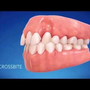 ŞEFFAF PLAK(İnvisalign) tedavisi nedir?