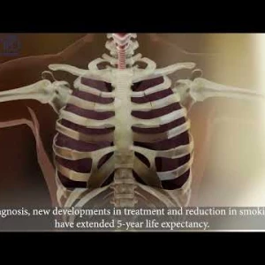 Akciğer Kanserinin Risk Faktörleri Nelerdir? What Are the Risk Factors for Lung Cancer?
