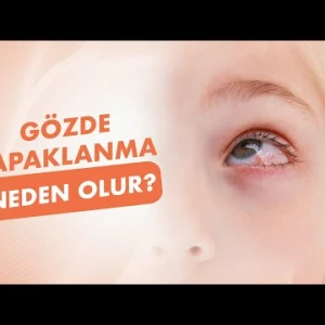Gözde Çapaklanma Neden Olur?│Doç. Dr. Faruk Kaya