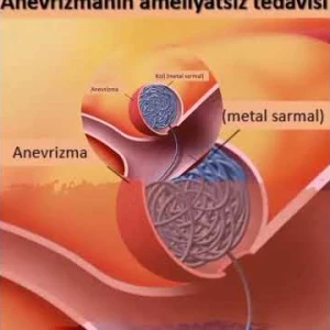 Damarda Baloncuk Nedir? Damarda Baloncuk Oluşumu Nedir?