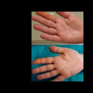 EL TERLEMESİ-PALMAR HİPERHİDROZİS