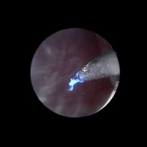 HoLEP video