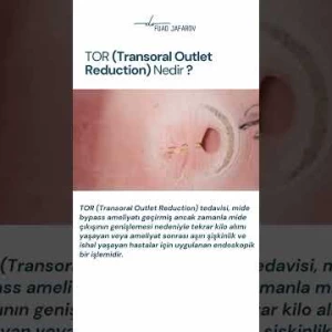 TOR (Transoral Outlet Reduction) Nedir ?