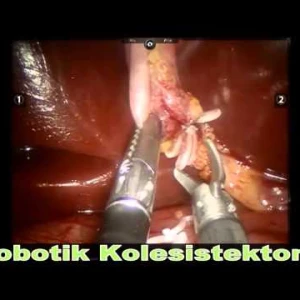 Robotik Kolesistektomi