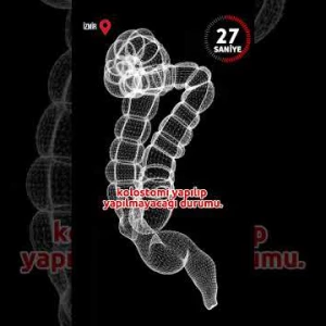 Rektum Kanserleri ve Tedavi Yöntemleri