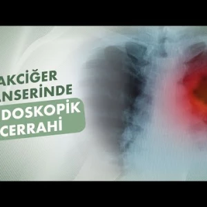 Akciğer Kanserinde Endoskopik Cerrahi│Prof. Dr. Güven Sadi Sunam