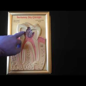 Dişlerde Çürük, Dental Dolgu ve Kanal Tedavisi