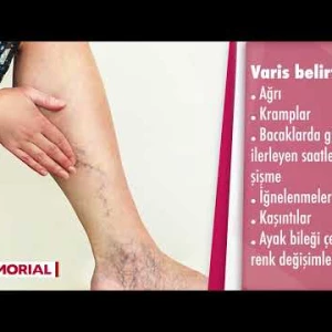 VARİS BELİRTİLERİ NELERDİR?