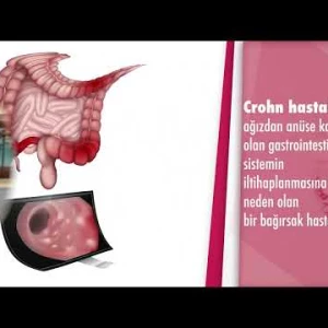 Crohn hastalığı nedir? Crohn hastalığı nasıl tedavi edilir? - Doç. Dr. Tolga Konduk