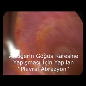 VİDEO-THORACOSCOPİC (VATS) WEDGE RESECTİON