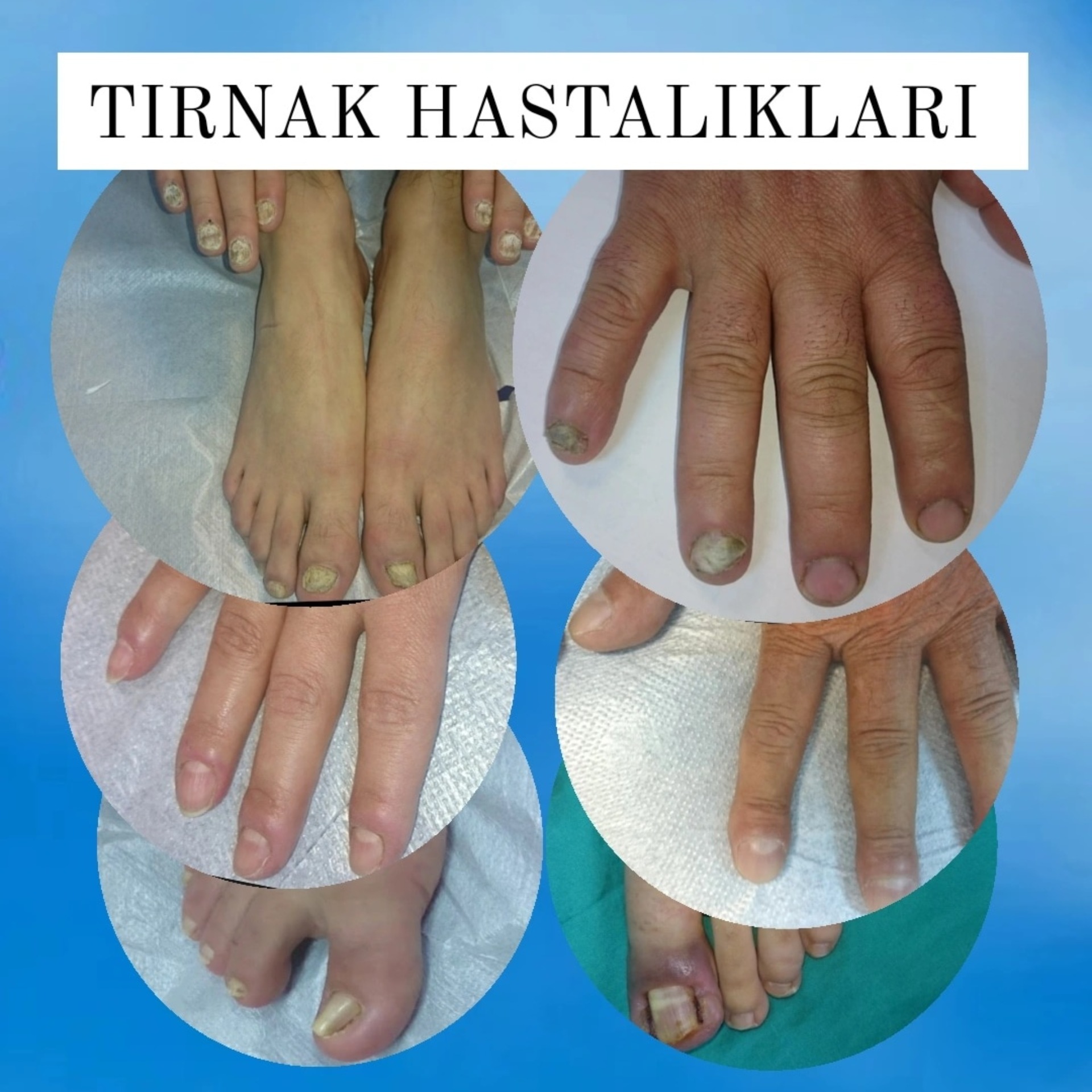 TIRNAK HASTALIKLARI