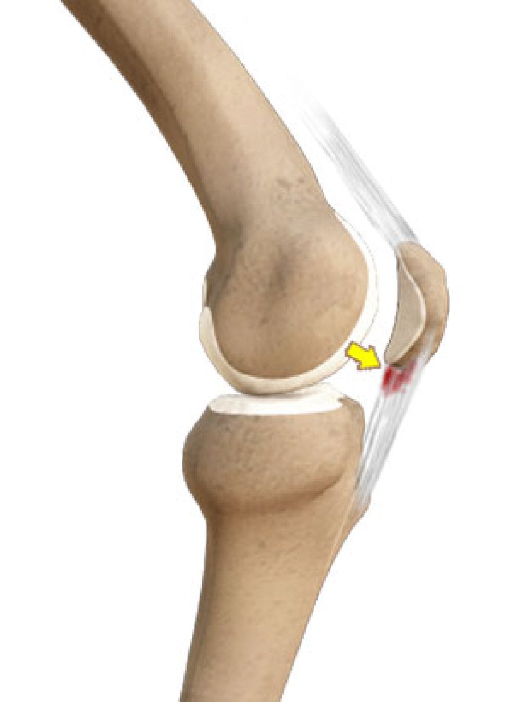 Patellar Tendinit ve Ön Diz Ağrısı
