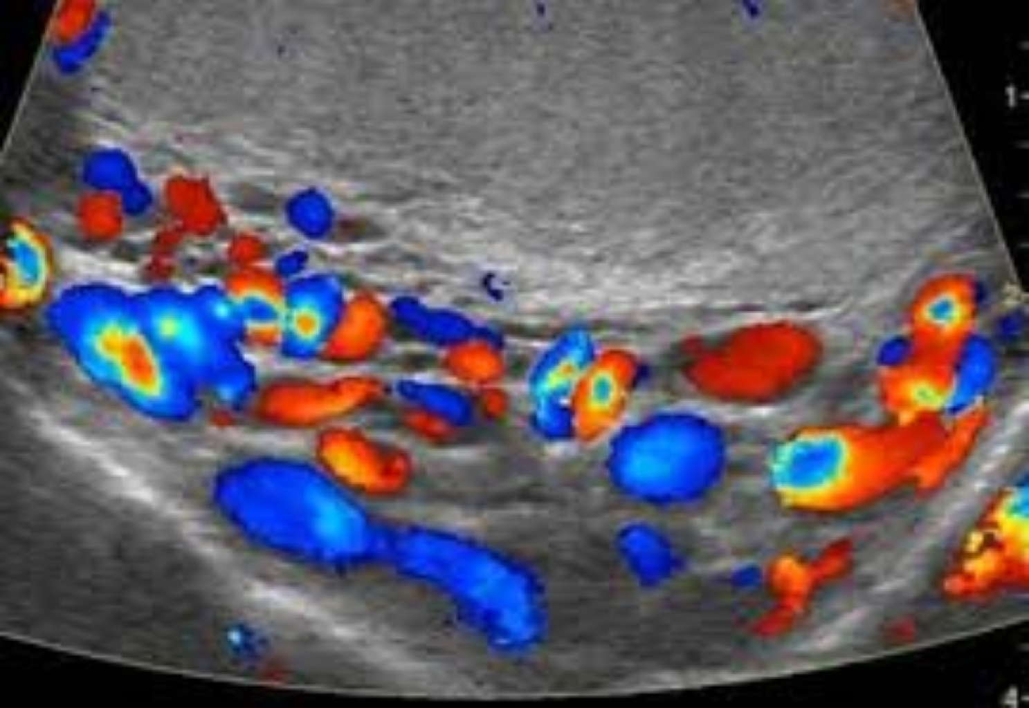 Skrotal Varikosel Renkli Doppler Ultrasonografi