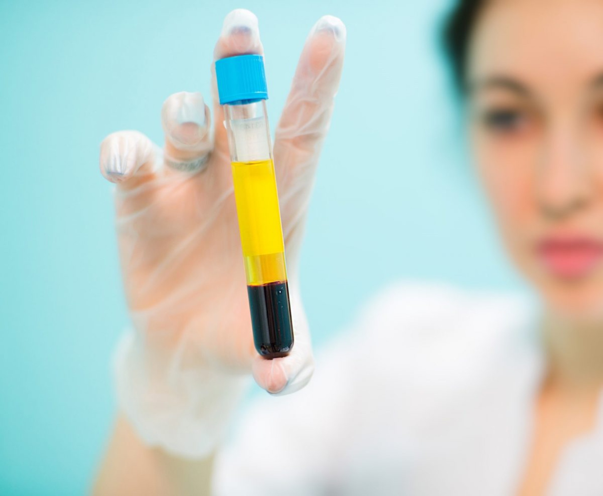 PRP (Platelet Rich Plasma)