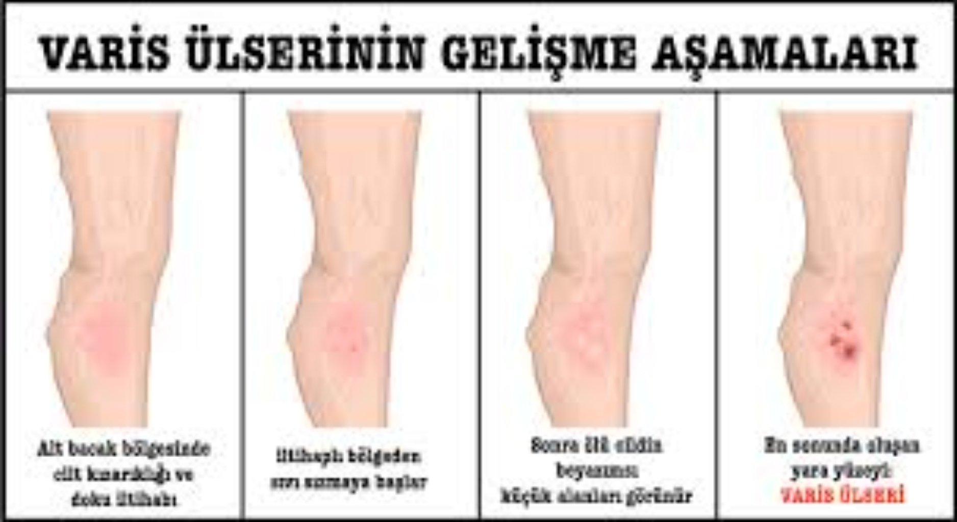 VARİS YARASI