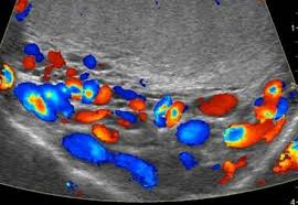 Skrotal varikosel renkli doppler ultrasonografi