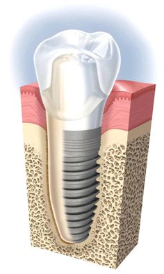 Eksik dişler ve implant