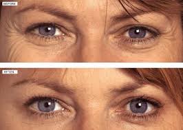 Botox  uygulamaları