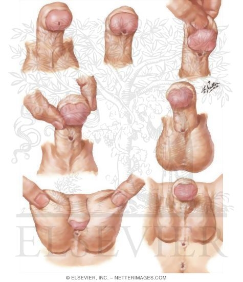 Hypospadias