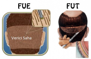Fue yöntemi ile saç ekimi