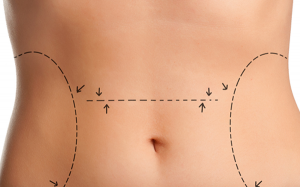 Karın germe (abdominoplasti) ve sonrası