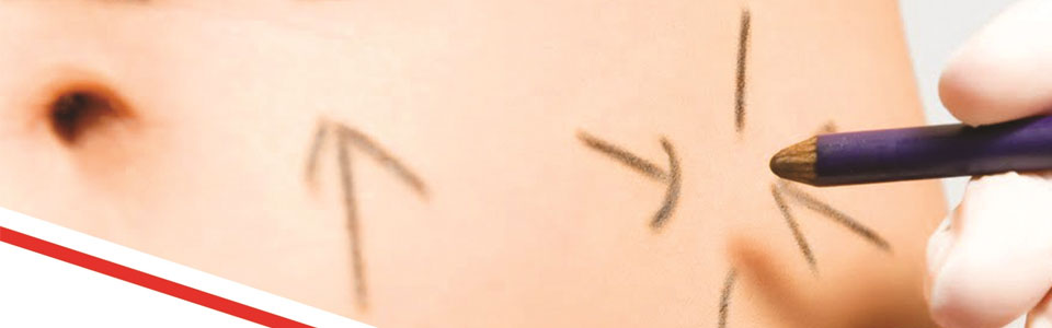 Mini karın germe ameliyatı (abdominoplasti ameliyatı)