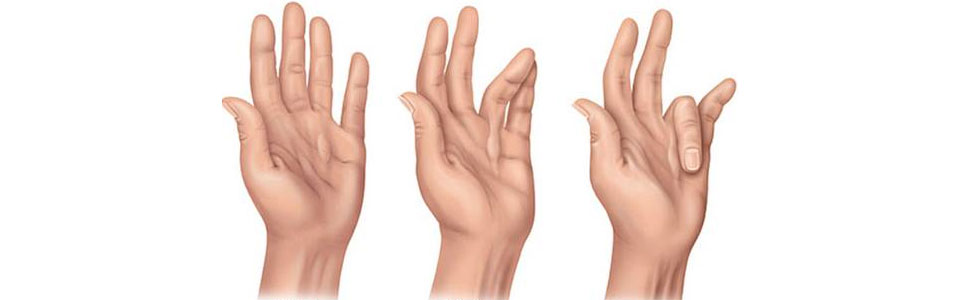 Dupuytren kontraktörü nedir?